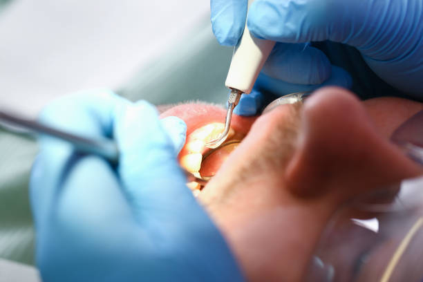 Best Emergency Root Canal Treatment in Clearfield, PA